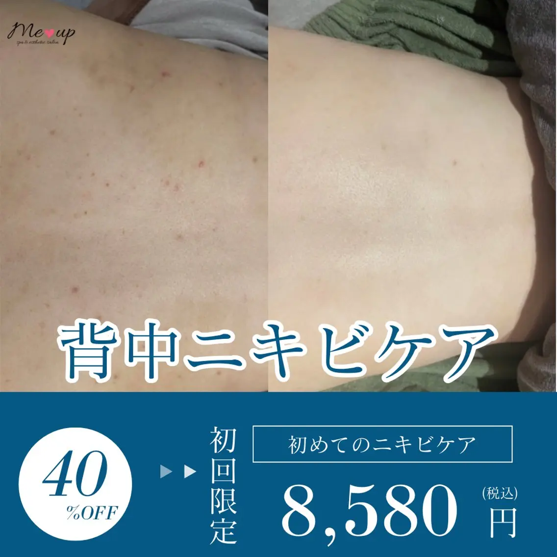 ご新規様★背中ケア★何を選んでいいかわからない方はこちら!の写真