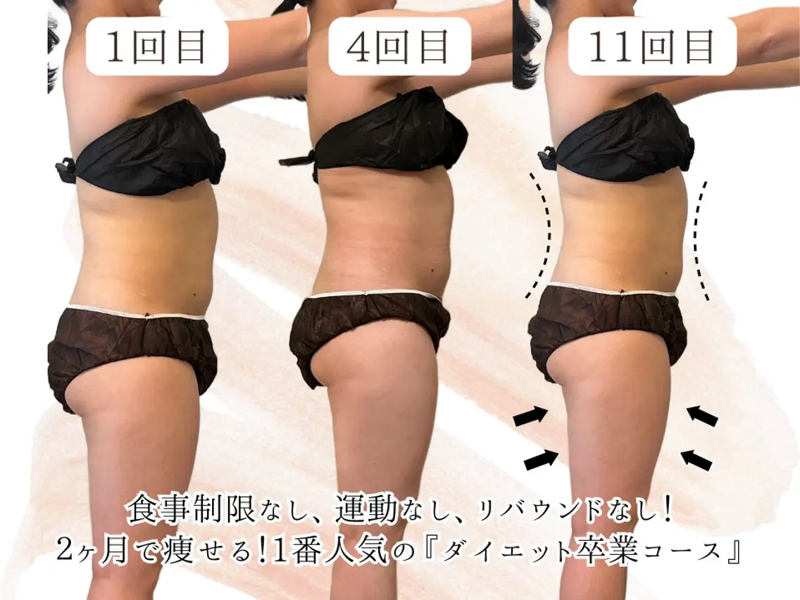 一番人気⭐︎ダイエット卒業コース！(水素吸入込み！) ¥11800 → ¥9800の写真