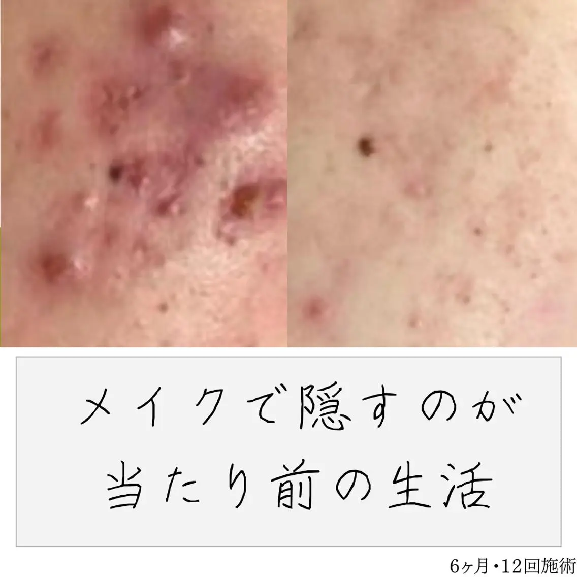 ニキビ経験者が施術 する専門サロン🌻のエステ・リラクイメージ