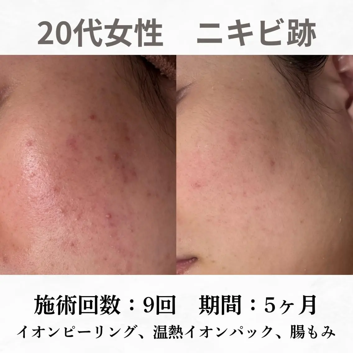 重度ニキビ専門🌼 ダウンタイムなしのエステ・リラクイメージ