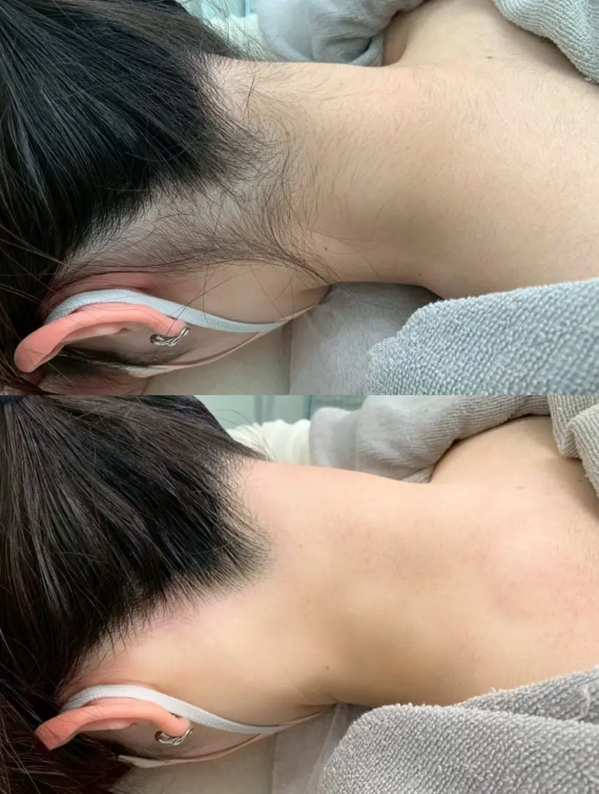 ☆夏前限定お得メニュー☆うなじ・背中上下脱毛の写真