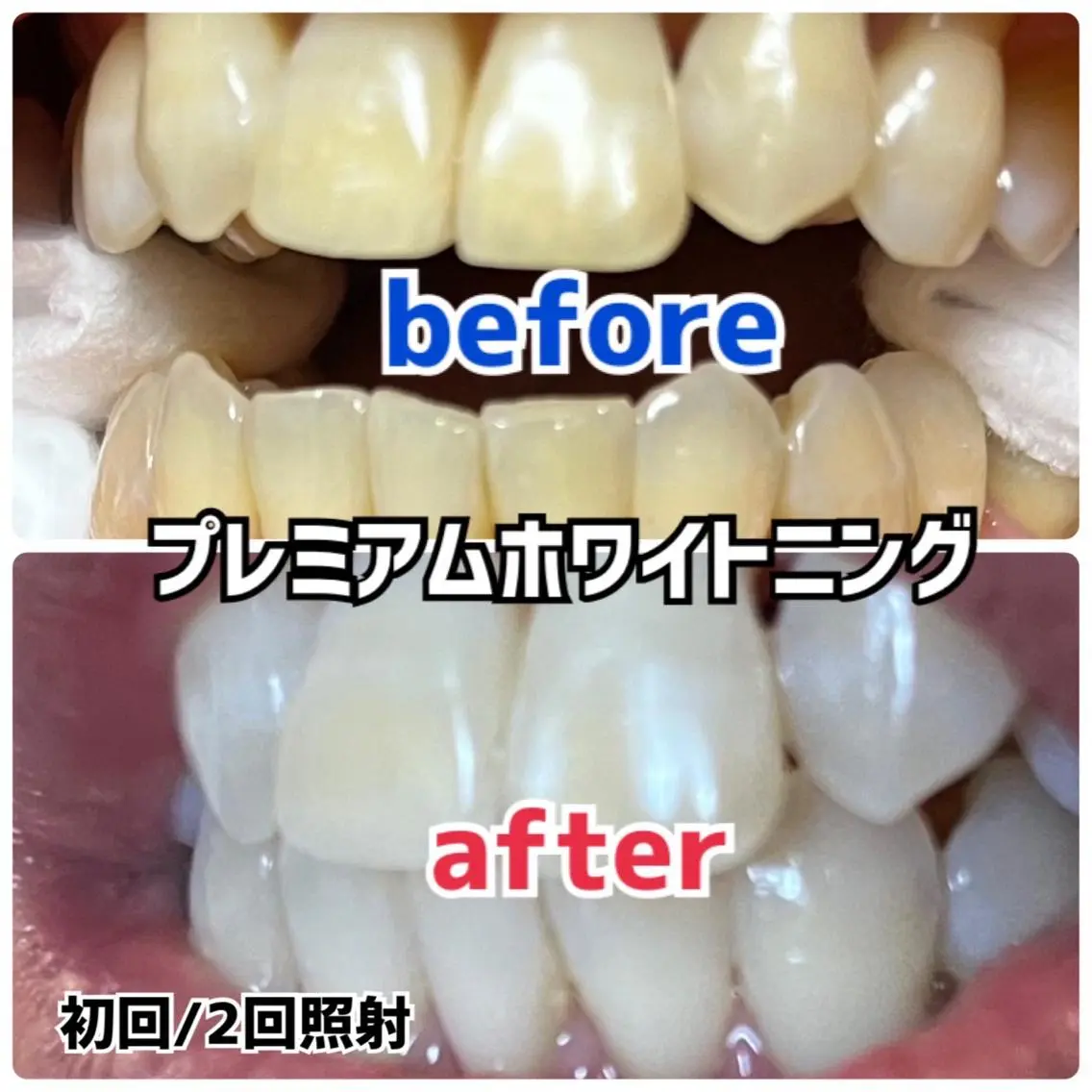 👩‍⚕️歯科医師監修！！ホワイトニング🦷染みにくく色戻りを最小限に❤️美ST雑誌掲載中💆‍♀️の写真