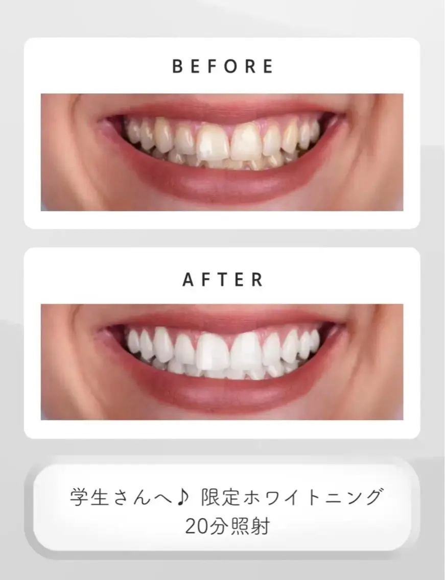 【学生さん必見！】ホワイトニングトリートメント付き🤍の写真