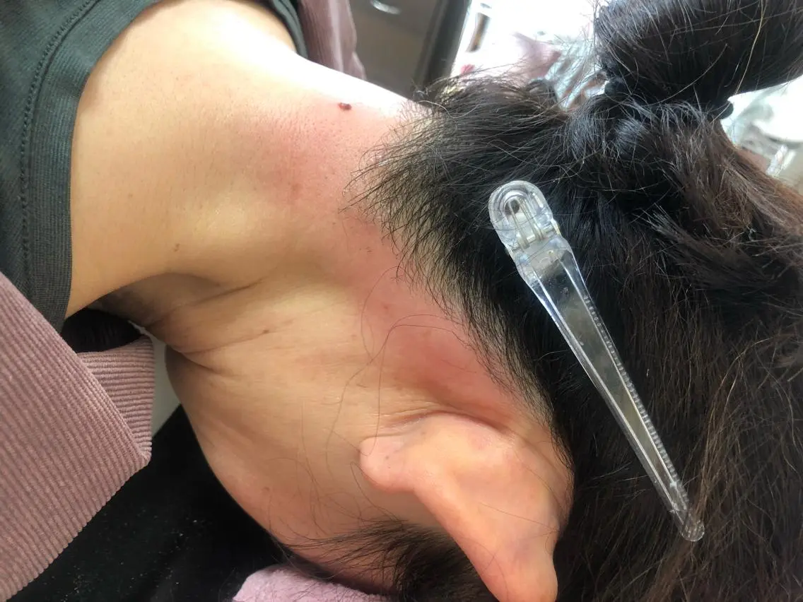 優しい顔とうなじのワックス脱毛✨✨眉毛も整います。顔と眉だけで3,500円うなじは、+1,000円です。ツヤピカ🌟の写真