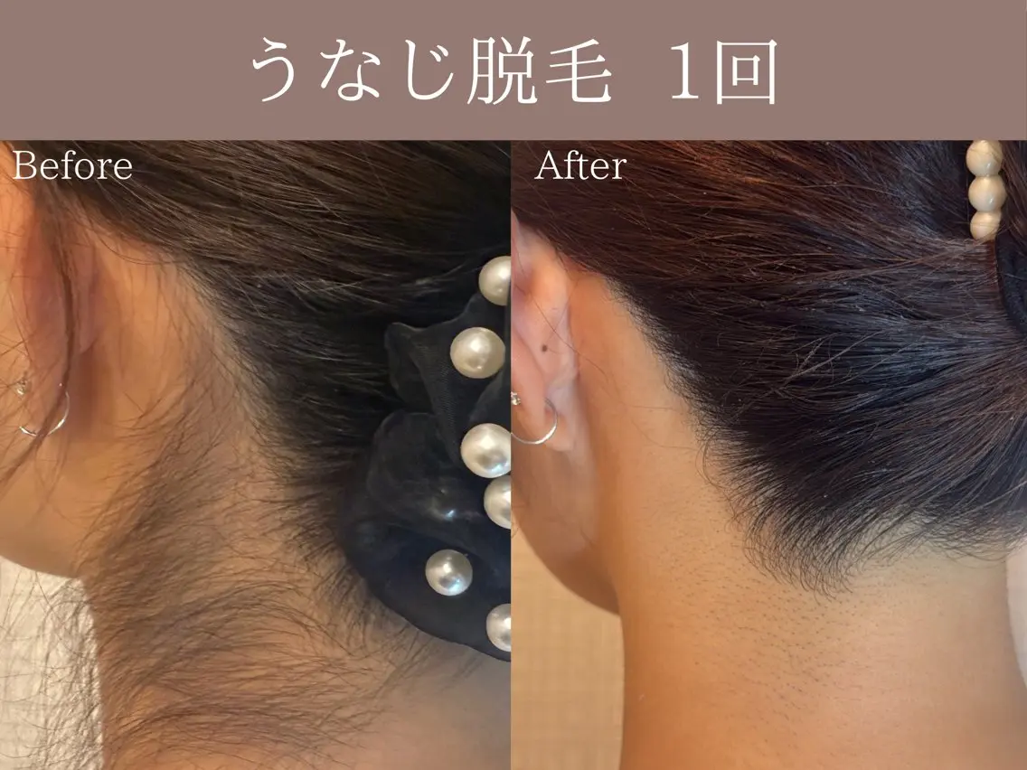 【U24ミニモ学割】美肌脱毛(小パーツ:うなじ)の写真