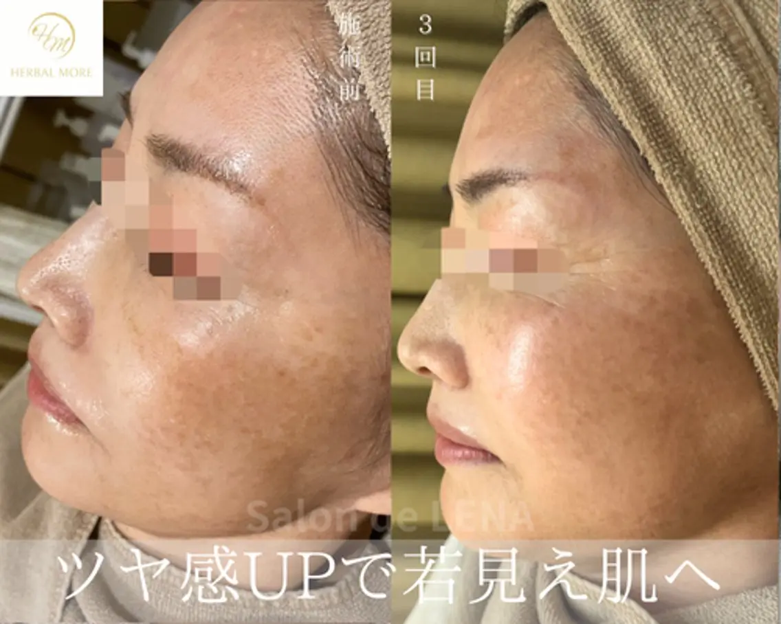 エステ ハーブピーリング専門 サロンドレナ平岡のエステ・リラクイメージ