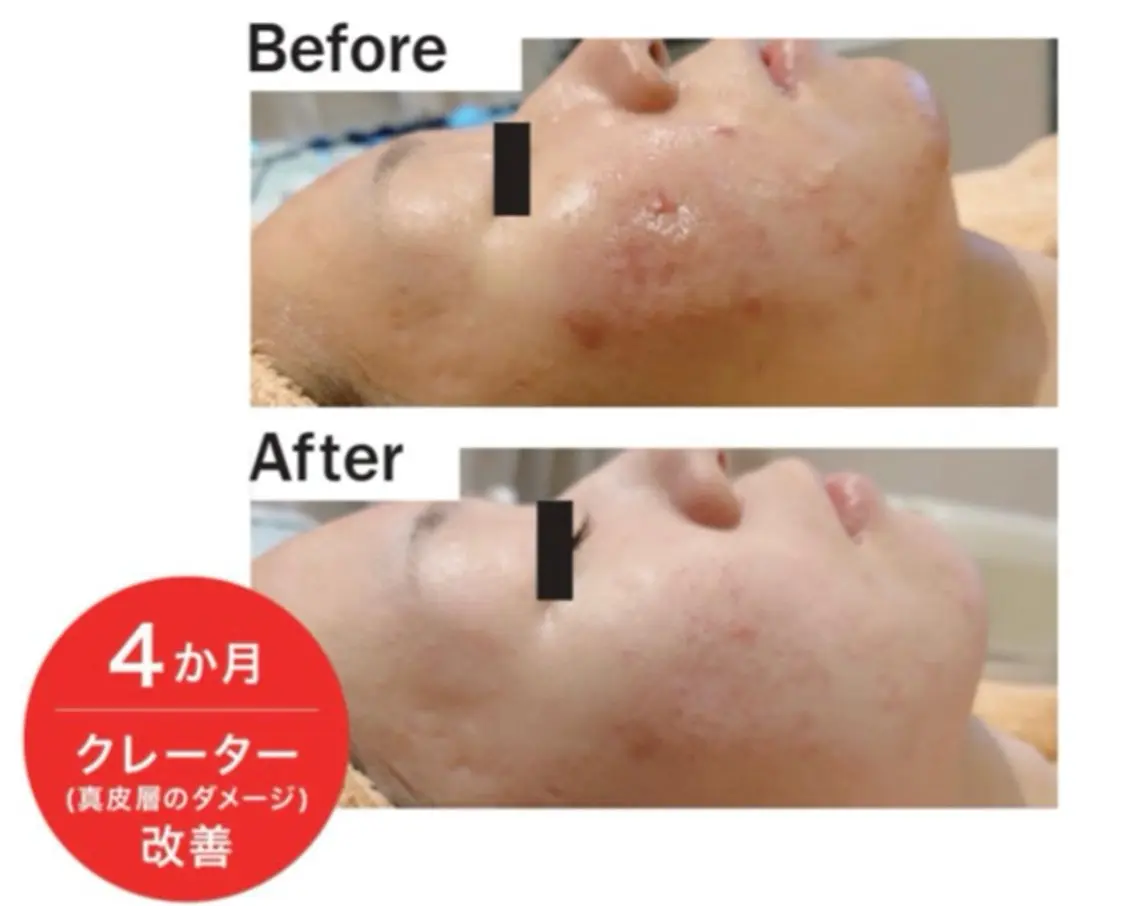 《エレクトロポレーション》幹細胞培養液導入で肌の再生力を高めます☆イオン導入の20倍の効果で肌の深層部まで浸透☆の写真