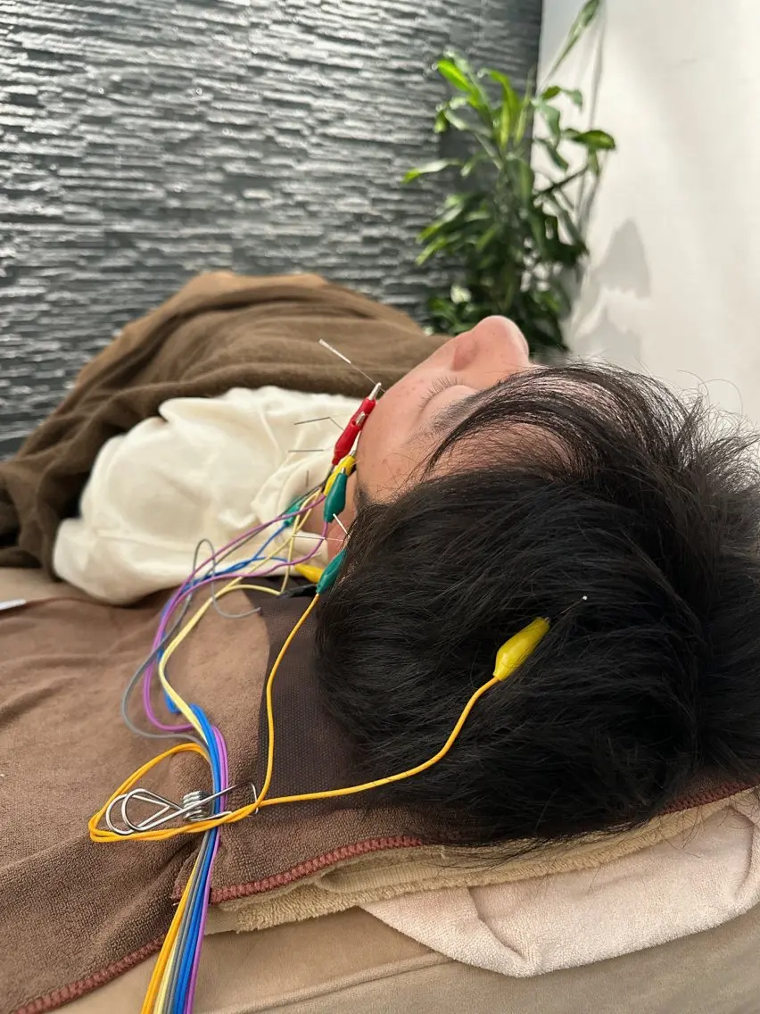 その他 小顔矯/美容鍼/鍼灸 BeauJuのその他イメージ