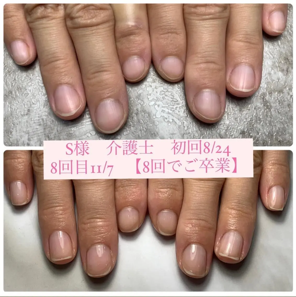 ネイル 自爪育成/深爪矯正 mikiのネイルデザイン