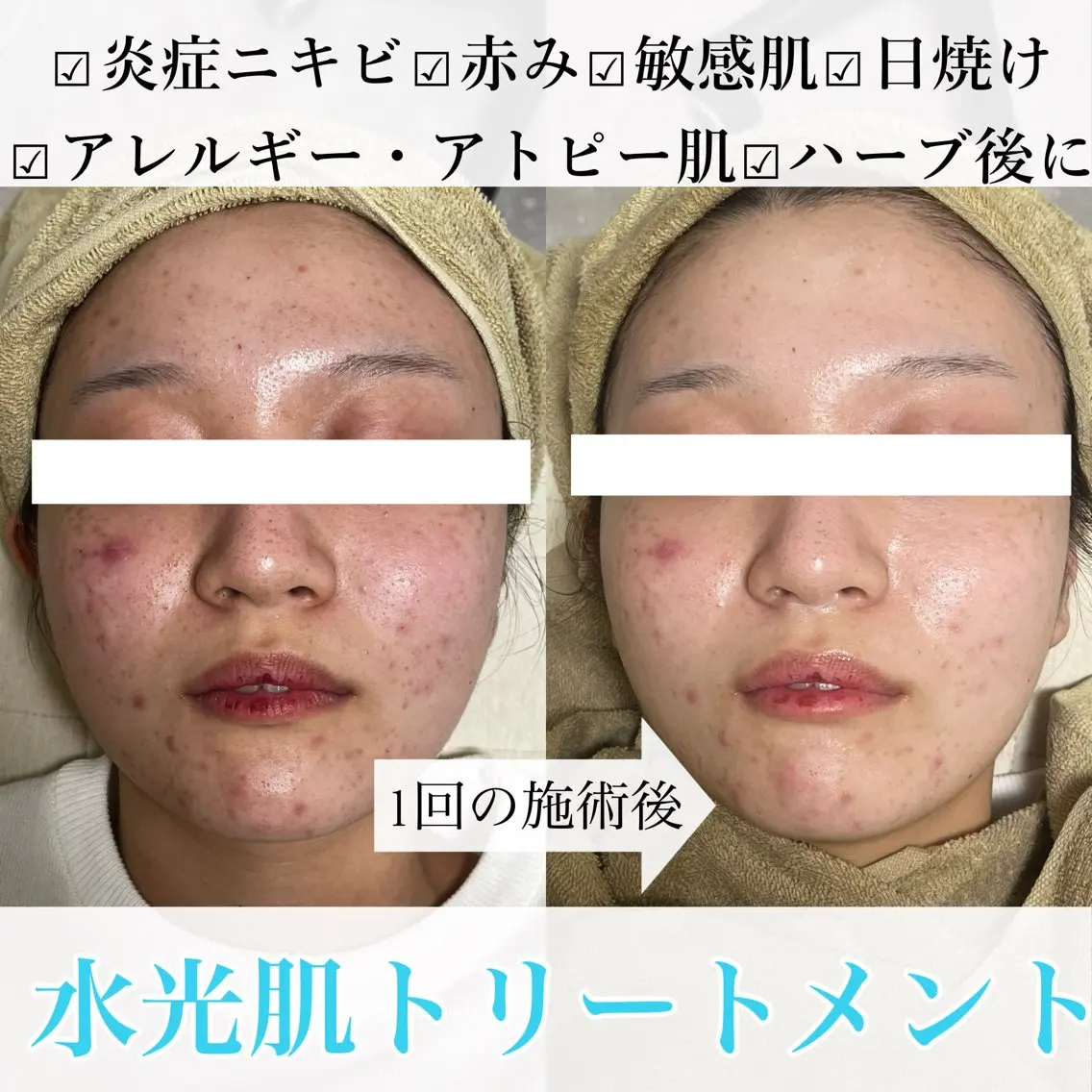 ニキビ撲滅👊🫧‪レストセルトリートメント‪ 《マッサージ有》🫧‪炎症ニキビ/敏感肌/日焼け/アレルギー/アトピー肌の写真