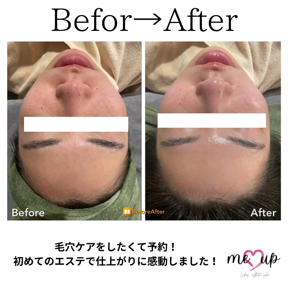 エステ Meupニキビ専門店 背中/ハーブ/肌管理のその他イメージ