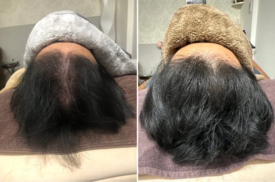 人気①メンズ育毛鍼真剣にお悩みは是非安心プライベートサロン💖18700→今だけの写真