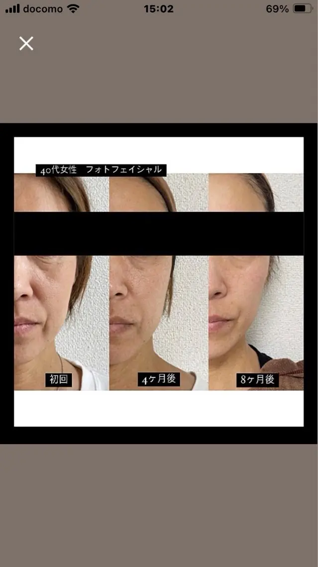 光フェイシャルの写真