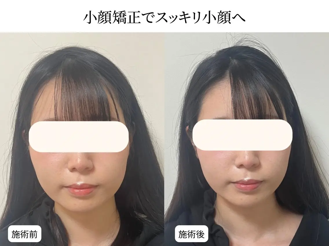 【エラ張り・むくみ改善】小顔整体＋4D小顔矯正＋姿勢矯正　12000円→の写真