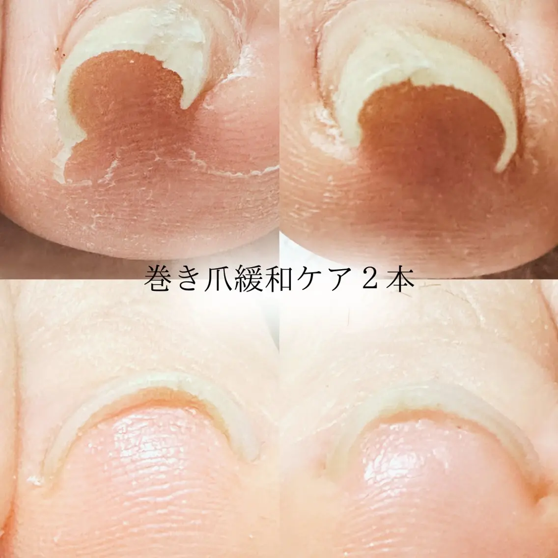 巻き爪ケア＜2本＞🎁の写真