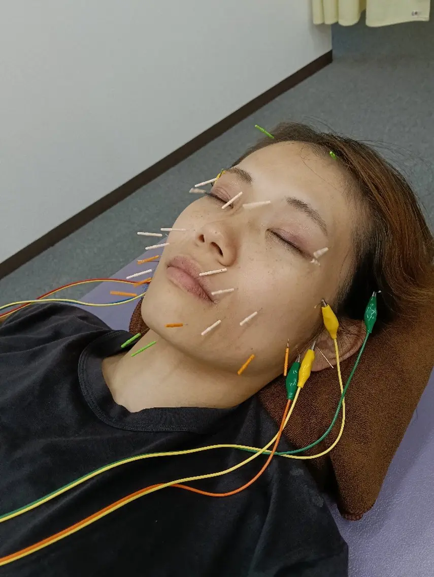 美容鍼! 鍼だけでなくお顔のマッサージもおこないます。の写真