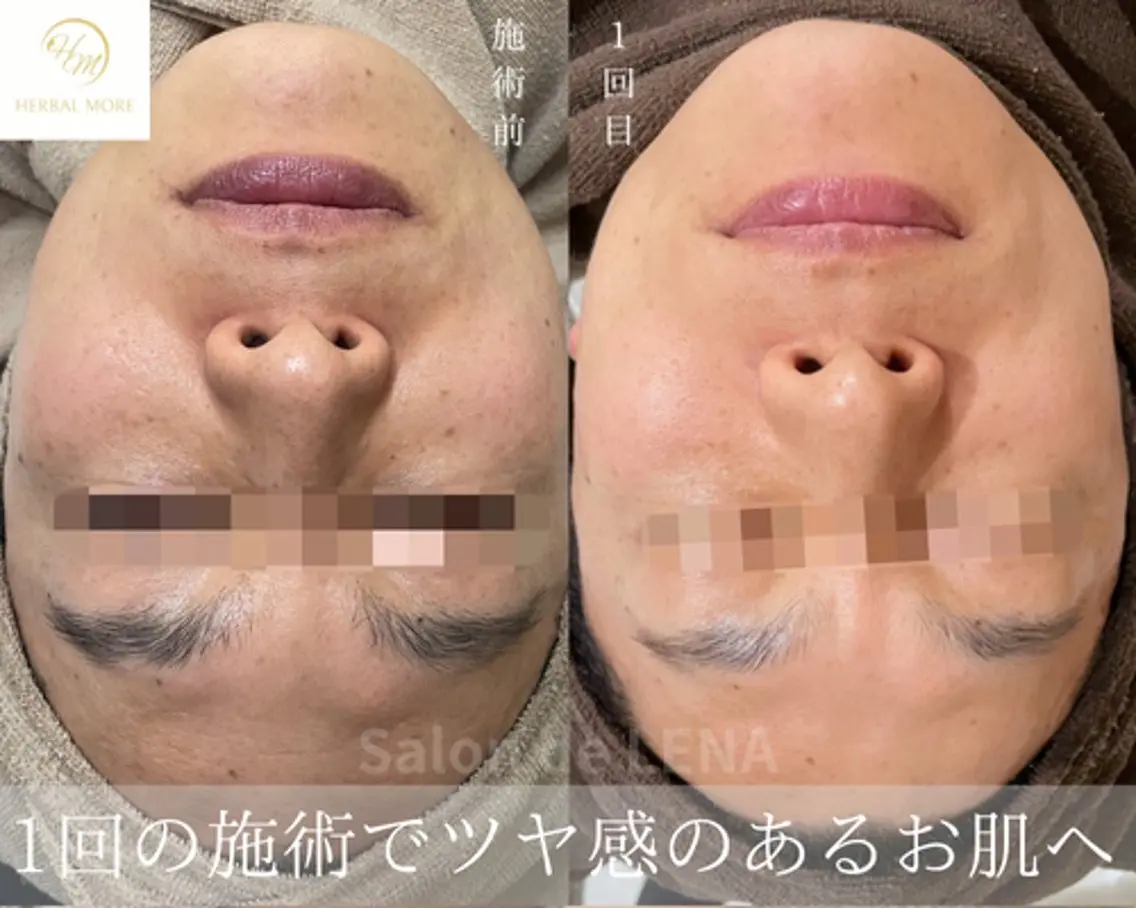 【ワンランク上の毛穴洗浄】1.5倍の洗浄力！毛穴引き締めトリートメント付きの写真