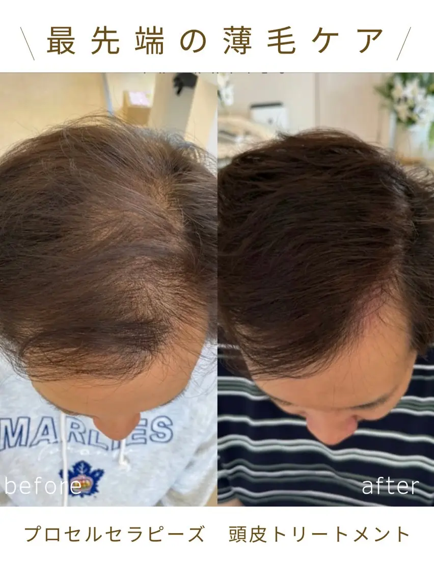 育毛促進プロセルセラピーズ※モニター様の写真