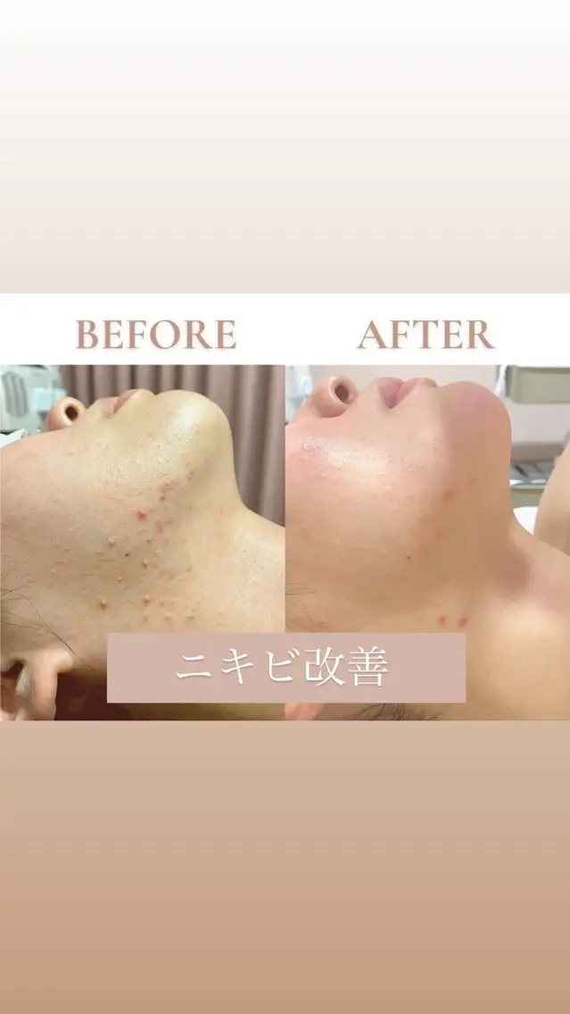 【繰り返す肌荒れ•ニキビに】🌷ニキビケアフェイシャル🌷の写真