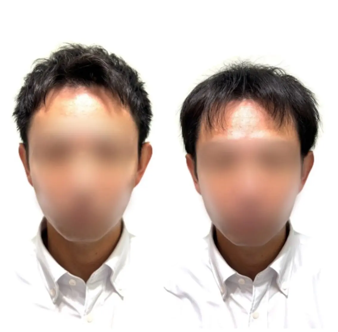 【顔出しNG】薄毛に悩む方のカット、シャンプー、ヘアセット。ホームページ、SNS等掲載用のお写真、動画の撮影。の写真