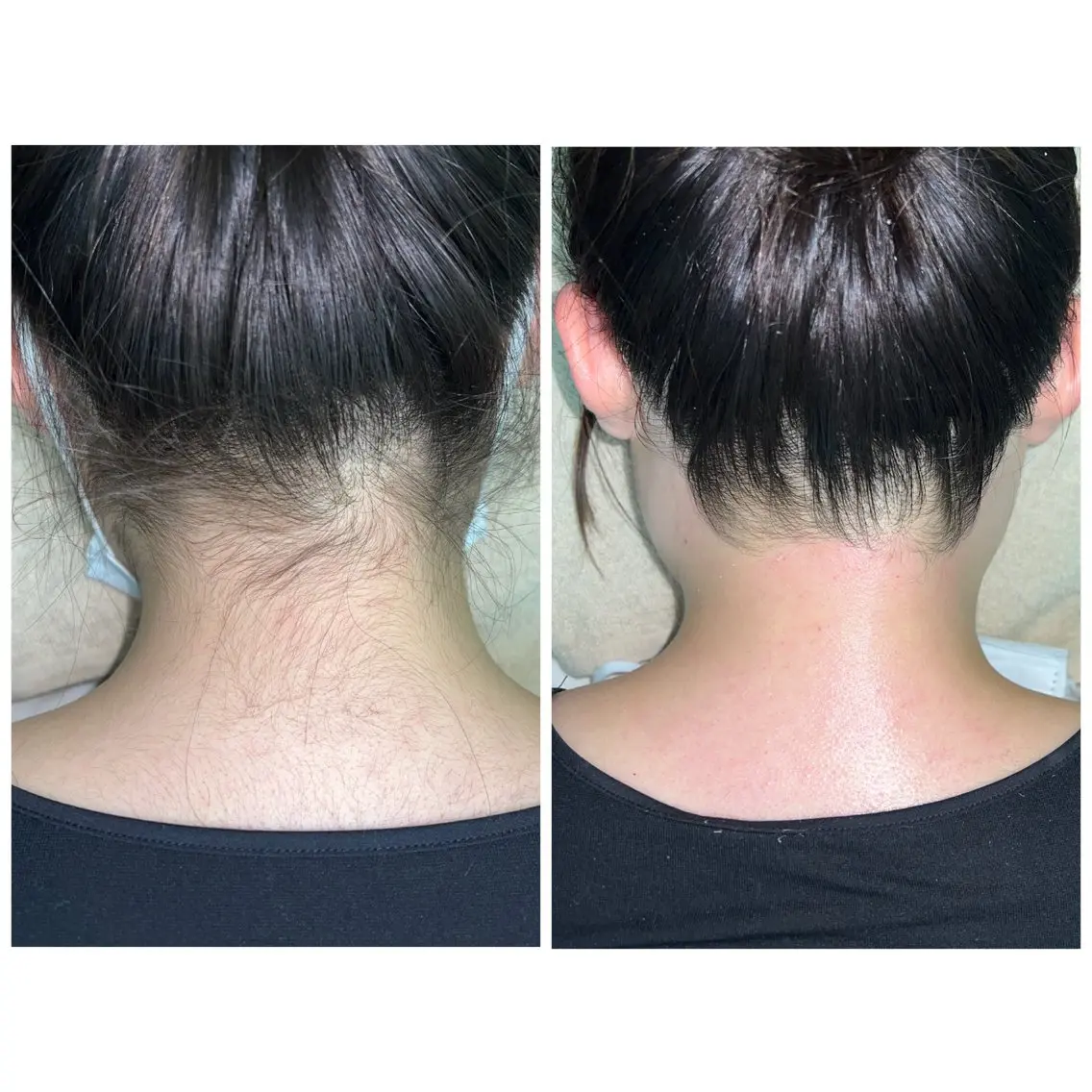 【学生から人気】うなじWAX（産毛・くすみケア）の写真