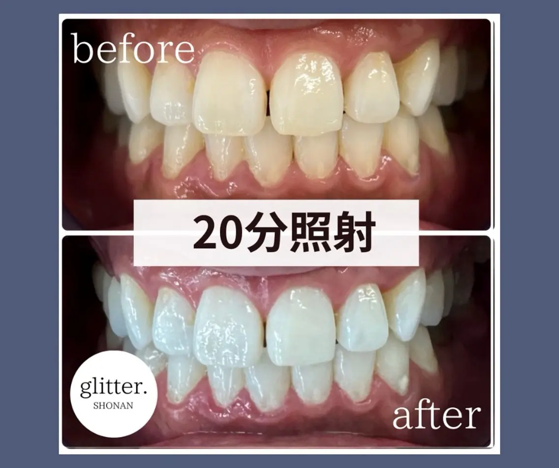 ネイル ホワイト ホワイトニング専門店 glitterのその他イメージ