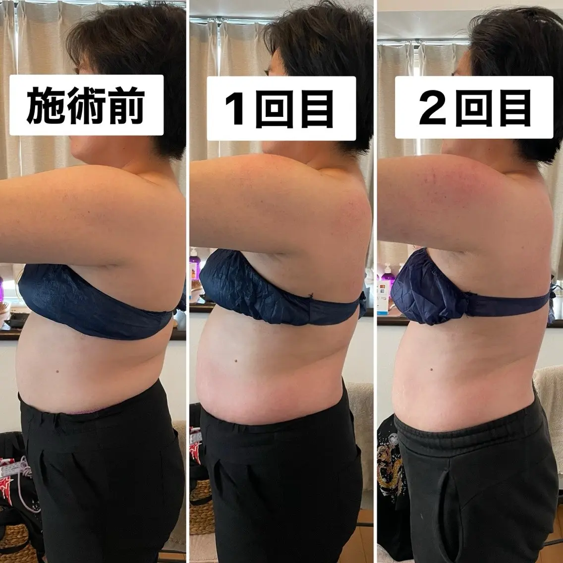 ミニモ新規限定価格🌼上半身or下半身集中痩せ💗東洋痩身【スライドカッピング60分】むくみ/セルライト/筋膜リリースの写真