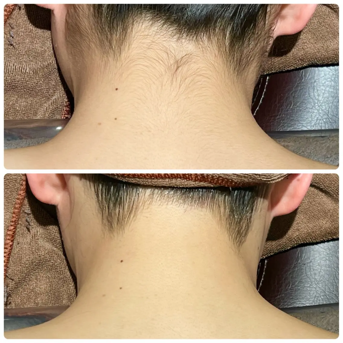 【うなじ背中美人目指しませんか✨️】 うなじ・背中セット脱毛  1回の写真