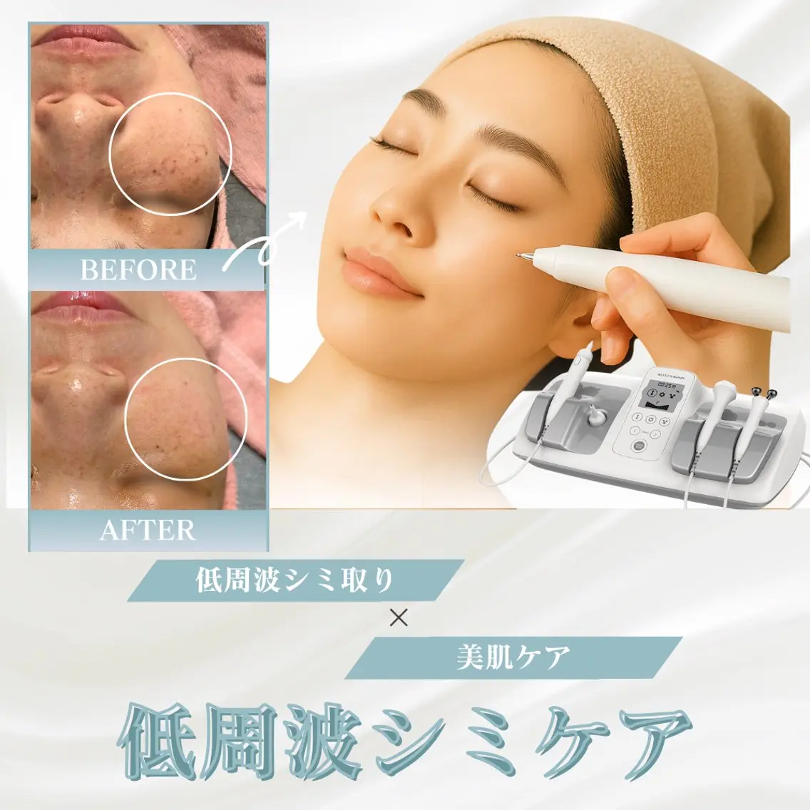 【本日31日1名様限定❗️】低周波シミ取り20分間当て放題◎1週間でポロッと排出✨シミ/そばかす/ニキビ跡に◎の写真