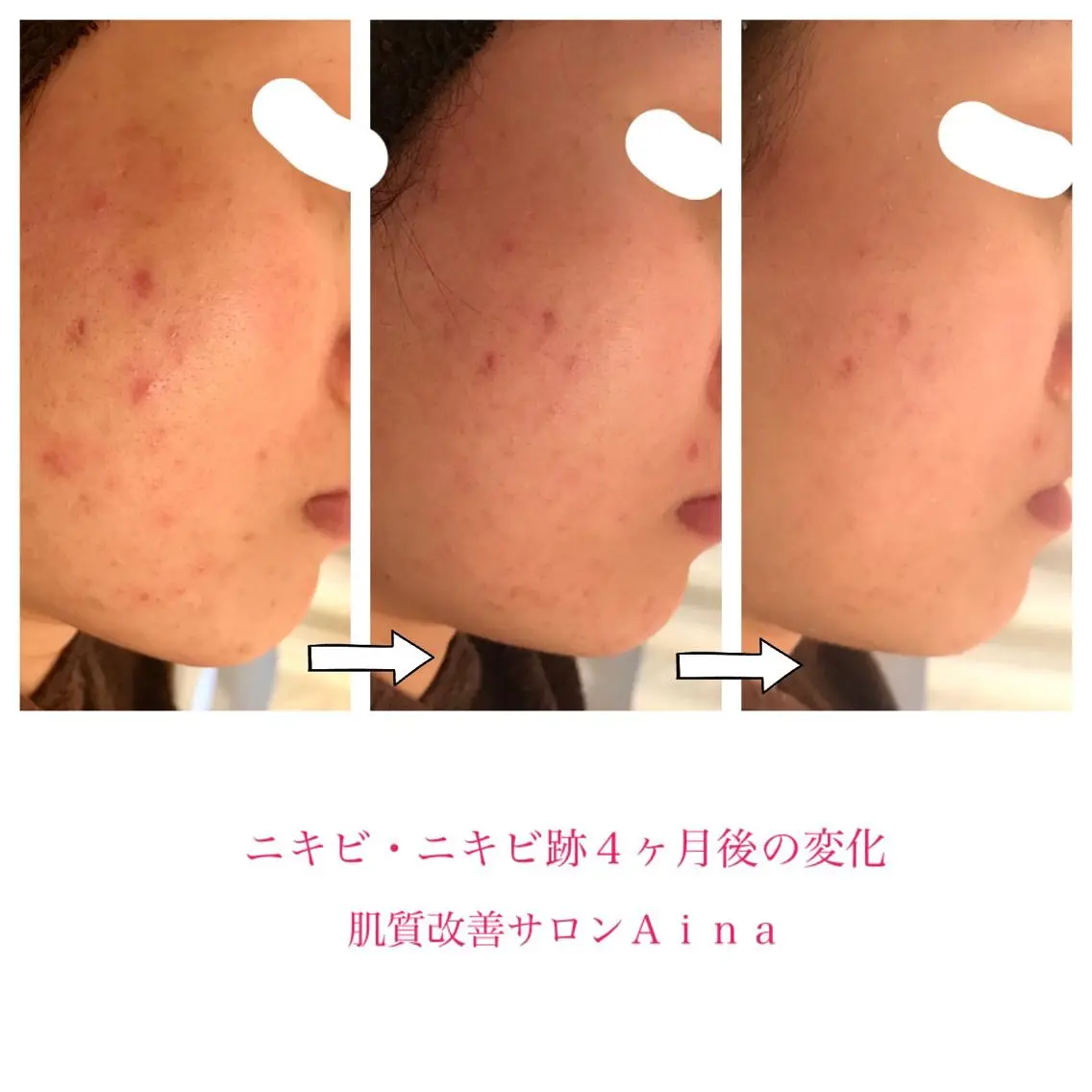 セミロング ヘアアレンジ キッズ ネイル マツエク・マツパ ニキビ跡専門サロン Ainaのエステ・リラクイメージ