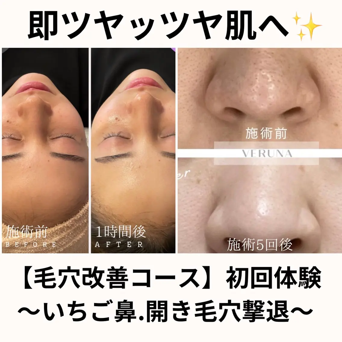 【即実感】毛穴引き締めケア（剥離なし）通常12,000円の写真