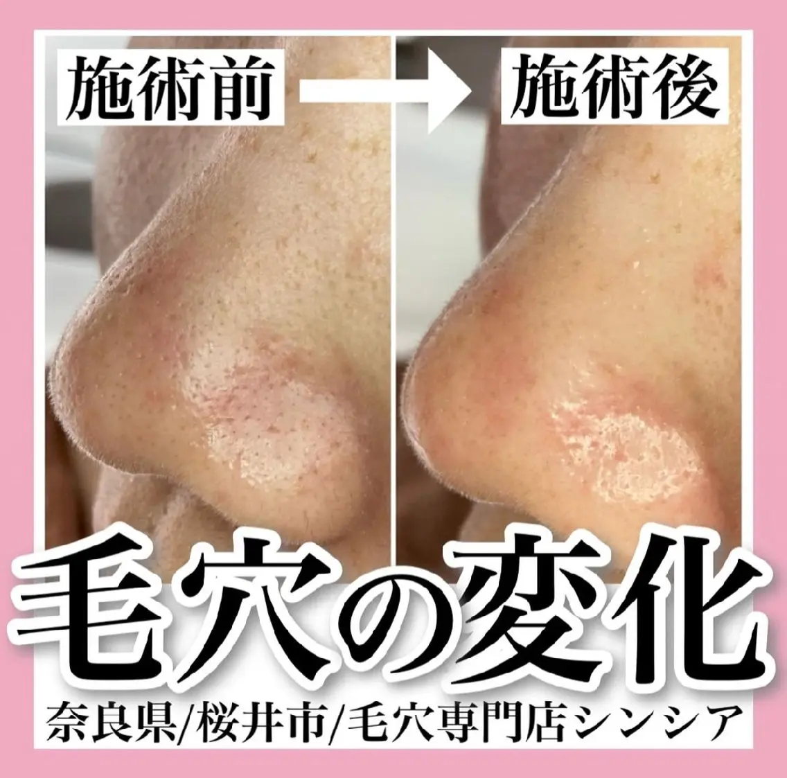 毛穴ケア【スペシャル】デコルテ付の写真