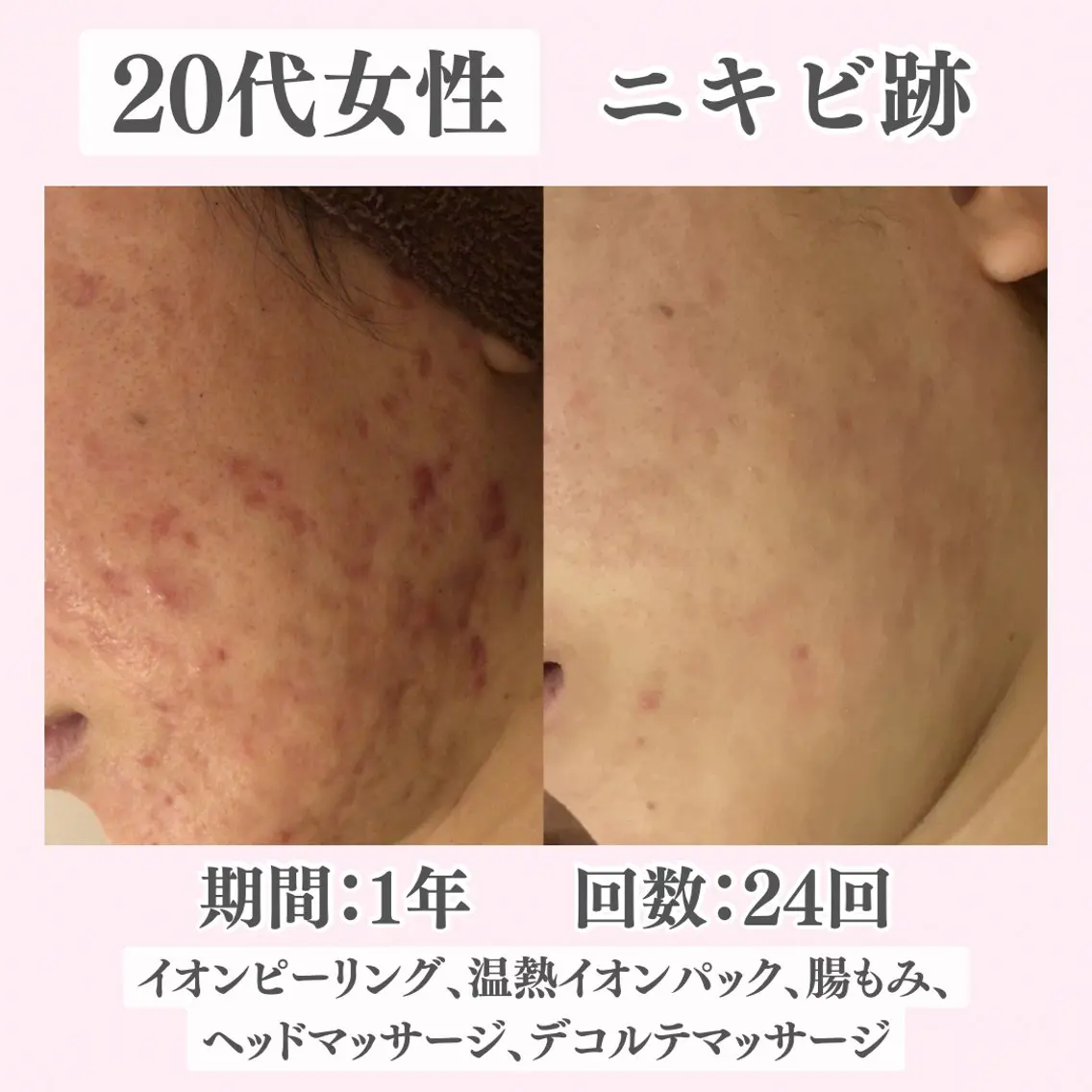 エステ リラク ニキビ・肌質改善専門 ♡人生が変わるサロンのエステ・リラクイメージ