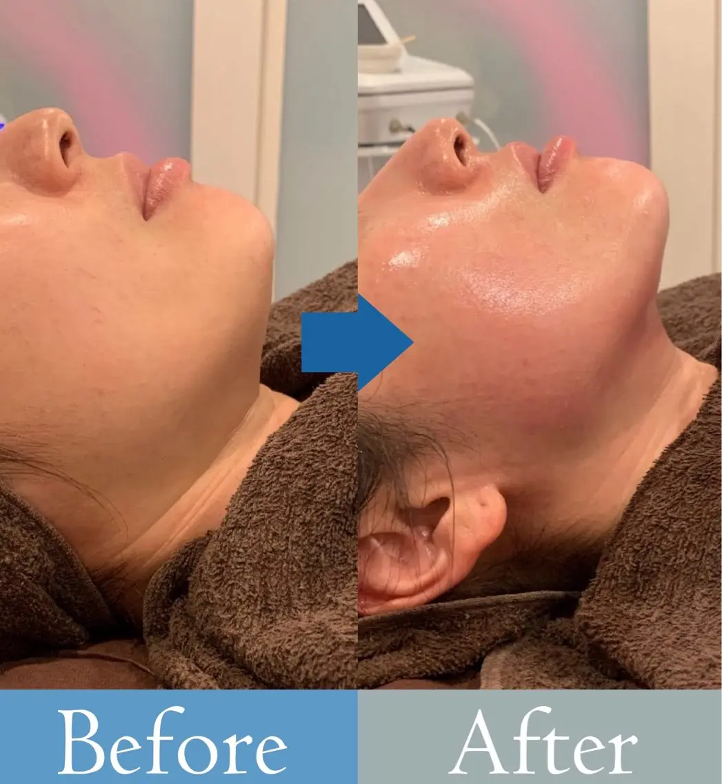 Facial【驚くほどの小顔✨ミニモ限定🉐】驚くほどの小顔❣️フェイシャル4000shot+美顔器+軽いマッサージの写真
