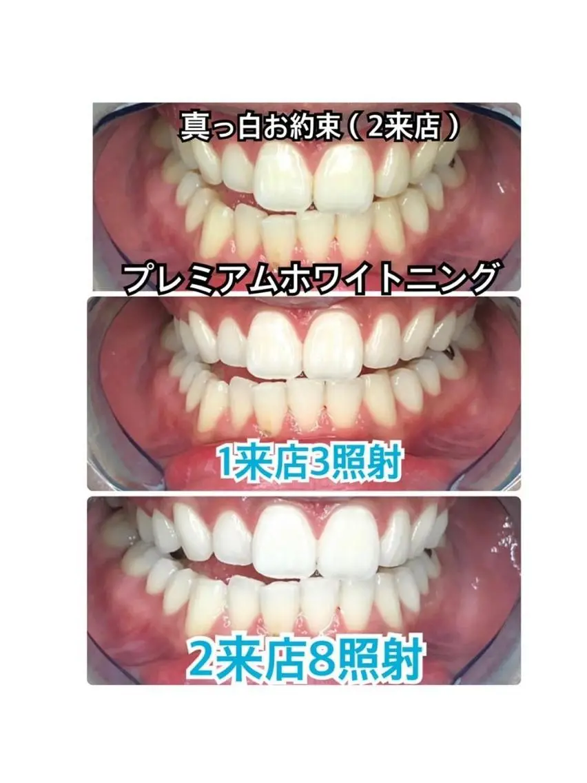 【周りと差がつく白さをお約束✨】白さお約束ホワイトニング❣美しい白さをご体感したい方✨✨〈合計 70分照射 2 来店〉の写真