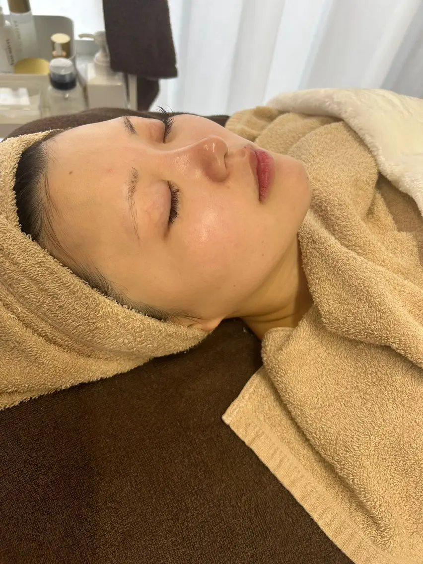 【艶肌再生Wケア★】ラレステンピーリング＋高濃度美容液導入◎の写真