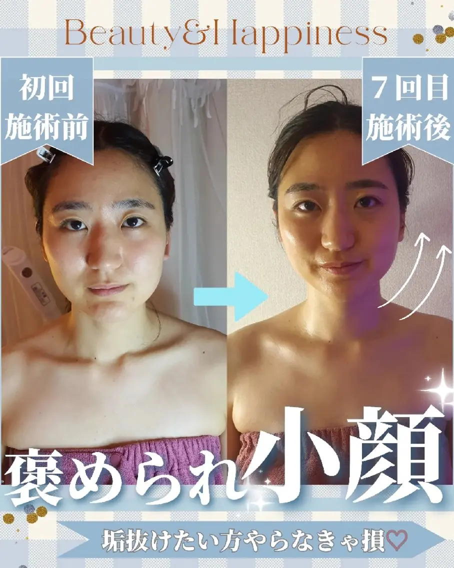 人気No.3🥇【🉐初回特別クーポン】瞬間☆小顔美人💖筋膜リリース┃韓国小顔┃二重あご撃退┃むくみ┃丸顔卒業の写真