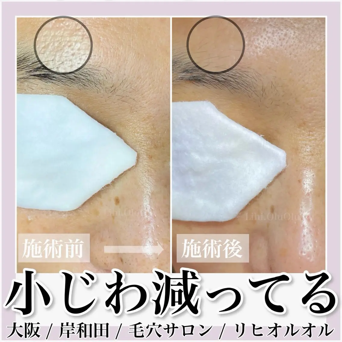 毛穴汚れ改善専門店/ 岸和田/リヒオルオルのエステ・リラクイメージ