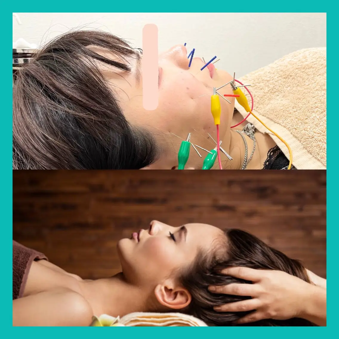 🎁電気美容鍼＋小顔矯正🎁日頃の疲れが特に顔に出やすい方はこちら🉐小顔になりながら身体や頭の疲れを取りたい方はこちらの写真