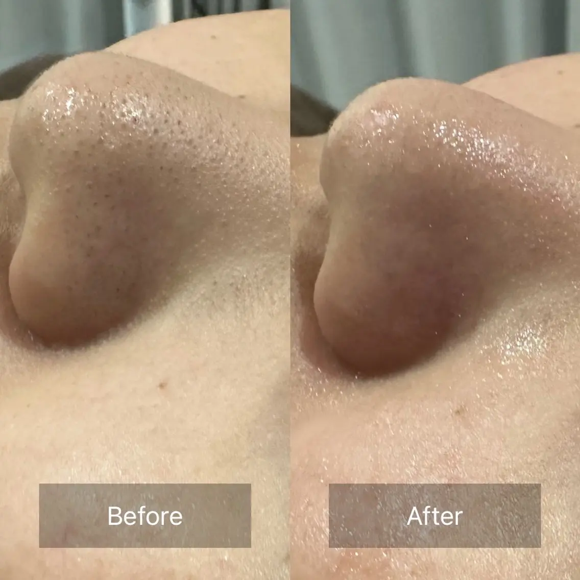 【お試しフェイシャルエステ💆‍♀️1,000円OFF】サヨナラ👋いちご鼻🍓メンズのお鼻限定洗浄🚿の写真