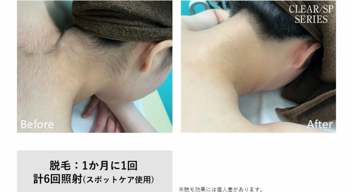 襟足脱毛の写真