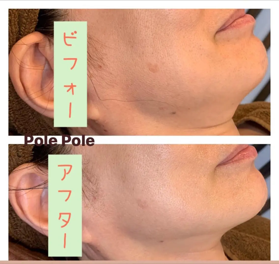 保湿コース(フェイシャル)の写真