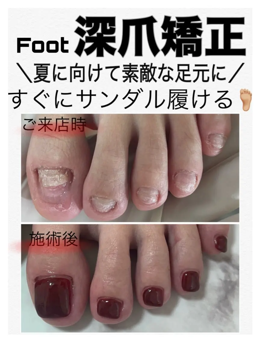 フット深爪矯正【長さ出し】◆ワンカラー◆(オフ込/フットバス付) むしったり 割れたり 小さくなった爪も綺麗な状態に✧︎の写真