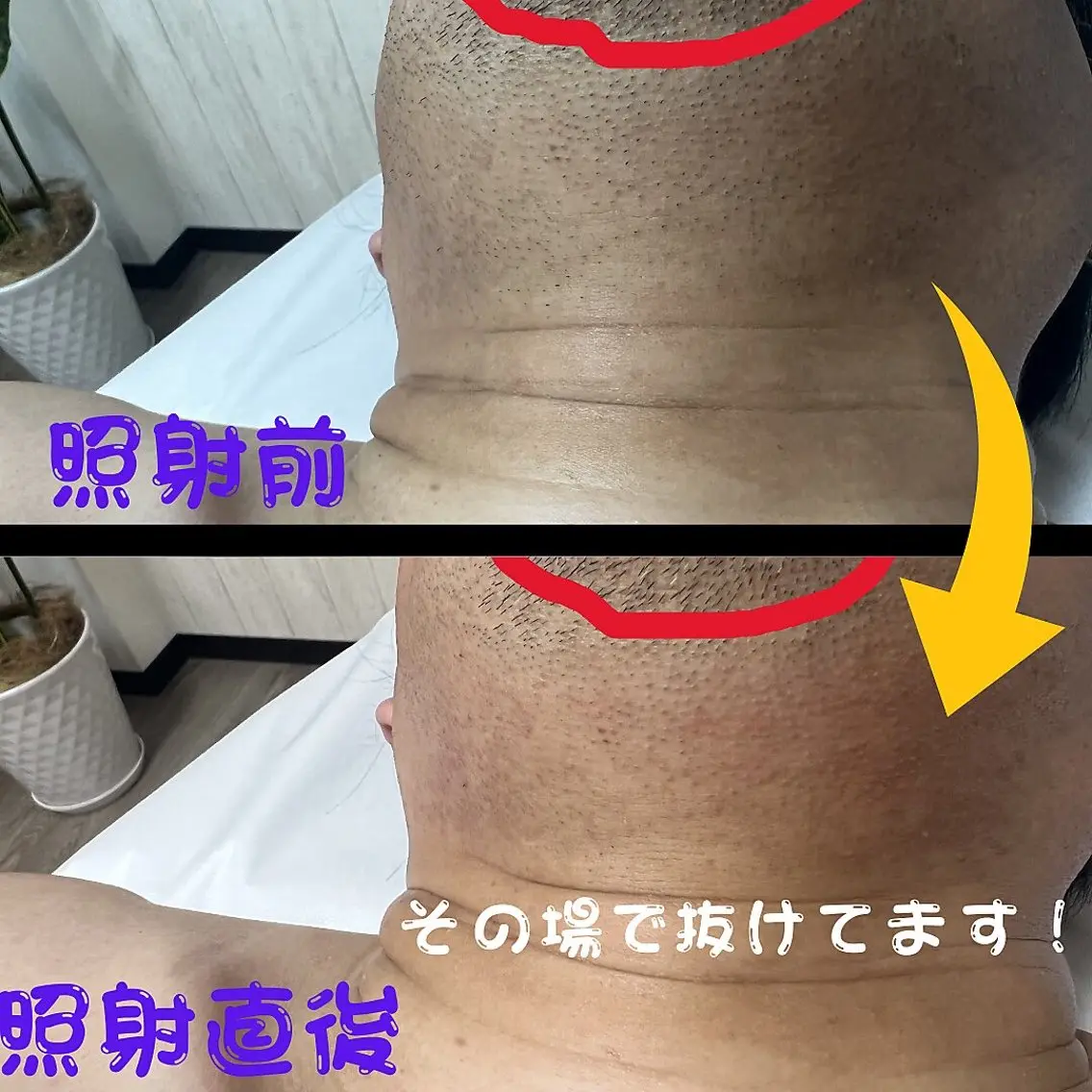 メンズ キッズ 脱毛 メンズ脱毛フェリッセ /男女🆗キッズ🆗のエステ・リラクイメージ