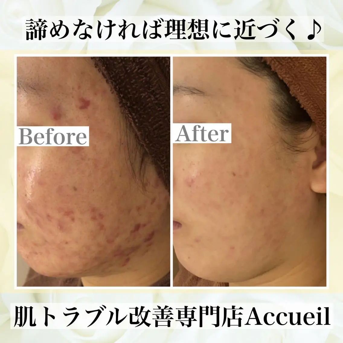 ミディアム カラー パーマ ヘアアレンジ メンズ キッズ ネイル マツエク・マツパ エステ リラク ニキビ・肌質改善専門 ♡人生が変わるサロンのエステ・リラクイメージ
