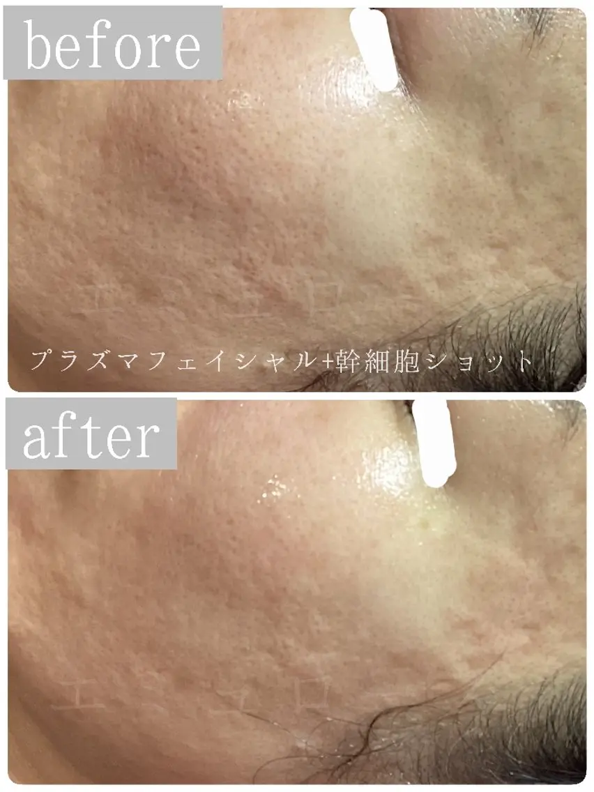 毛穴悩み・デコボコ肌が気になる方に!【プラズマ×ミプラス】の写真