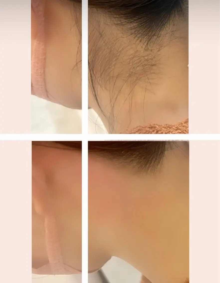 男女人気!うなじ脱毛の写真