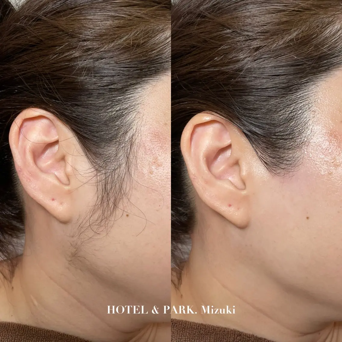 脱毛 HOTEL&PARK . ワックス脱毛のエステ・リラクイメージ
