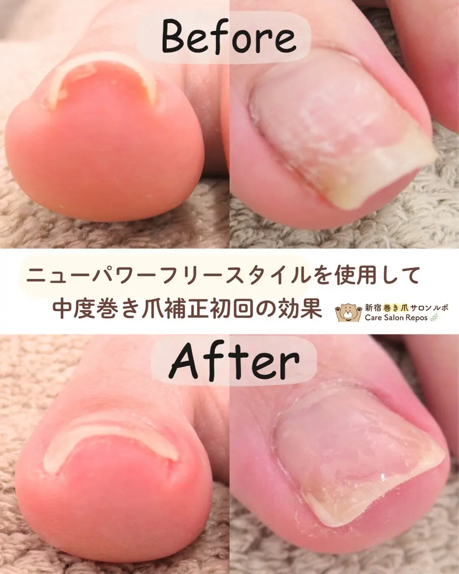 ネイル 新宿巻き爪ケア ルポのネイルデザイン