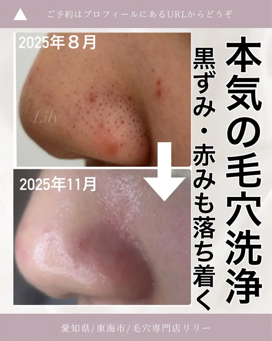 【毛穴ケアの最上級】毛穴集中コース💕最新毛穴技術でツルツルなお肌に🌿ヘッドスパ付きの写真